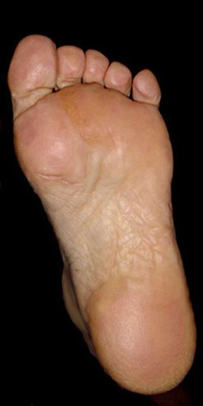 Dry Cracked Skin On Feet - upclever